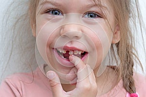 Child touching her staggering upper tooth next to lost one photo