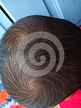 a child with two hair whorls