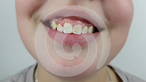 a child with uneven teeth color and spots smiles. dental examination dental treatment for children