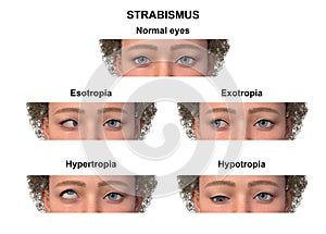 A child with various strabismus types, 3D illustration