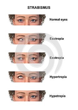 A child with various strabismus types, 3D illustration