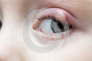 Close up right upper eye lid abscess, stye or hordeolum