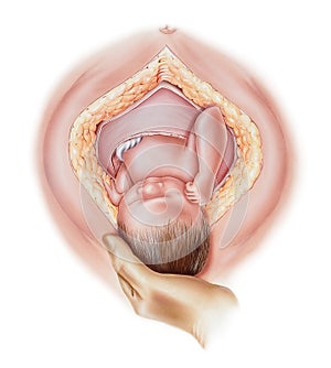 Childbirth - Cesarean C-Section