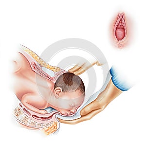 Childbirth - Normal Vaginal Birth