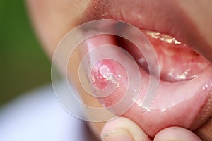 Children with aphtha on lip