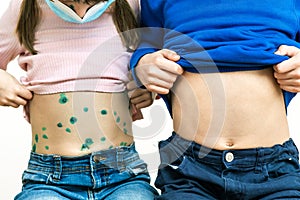 Children covered with green rashes on stomach ill with chickenpox, measles or rubella virus