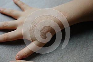 Children hand with atopic dermatitis. eczema on hand. psoriasis on kids hands