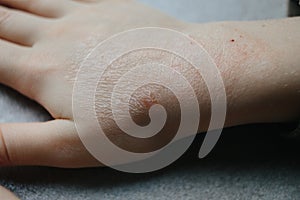 Children hand with atopic dermatitis. eczema on hand. psoriasis on kids hands