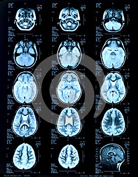 Children's head Magnetic risonance image