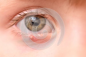 Children's right eye and swollen barley on the lower eyelid. Macro, close-up