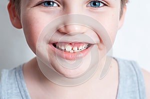 Children`s teeth, loss and fingers pointed at the incisor teeth, children`s mouths of child close up, incisor milk tooth missing