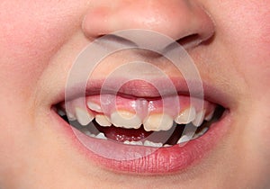 Children`s teeth. The molar grows in the second row. Anomalies of tooth growth photo