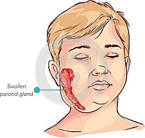 Children salivary gland swelling vector illustration