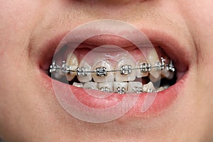 Children teeth with braces