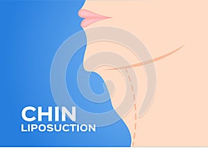Chin Liposuction before and after , fat , cosmetic skin