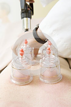 Chinese Traditional Cupping Therapy For Improved Circulation