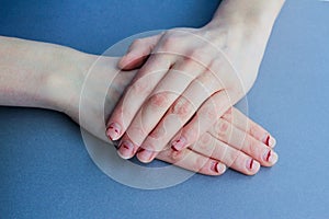 Chipped, stratified nails. nails after gel Polish. untidy hands on a blue background photo