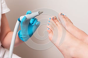 Chiropodist holding a handle of hardware peeling. Close up of female feet with ingrown toenails. The concept of