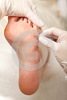 Chiropodist removes skin on a wart
