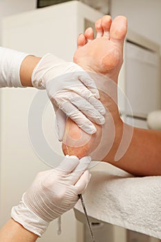 Chiropodist removes skin on a wart