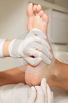 Chiropodist removes skin on a wart with photo