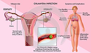 Chlamydia infection in females photo