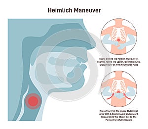 Choking first aid. Heimlich maneuver procedure to remove a foreign