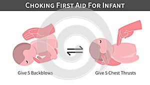 Choking First Aid For Infant cartoon illustration . Back blows and switch with chest thrusts . Flat design . Vector