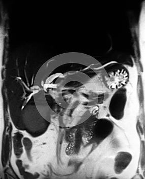 Cholangiogram gallbladder stones cholecystosis mri