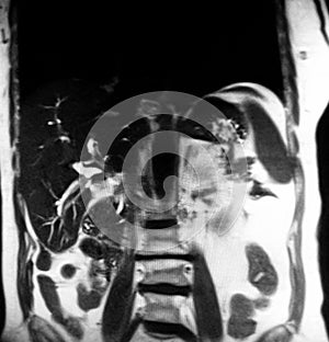 Cholangiogram gallbladder stones cholecystosis mri