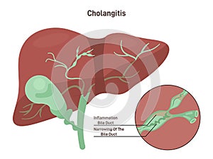 Cholangitis or ascending cholangitis. Infection and imflamation photo