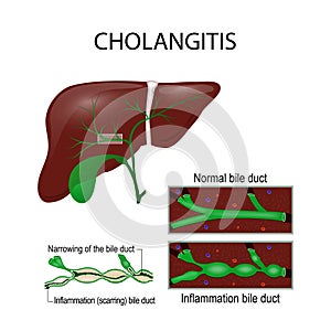Cholangitis. Cross section of the human liver, bile duct, and ga