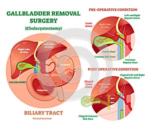 Cholecystectomy - Gallbladder removal surgery, anatomical vector illustration diagram with operative conditions.