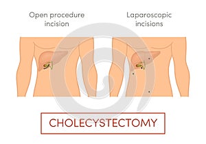 Cholecystectomy illustration