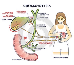 Cholecystitis as gallbladder inflammation from gallbladder outline diagram photo