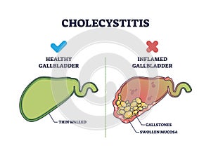 Cholecystitis as inflamed gallbladder compared with healthy outline diagram photo