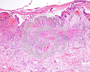 Gangrenous cholecystitis photo