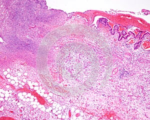 Gangrenous cholecystitis photo