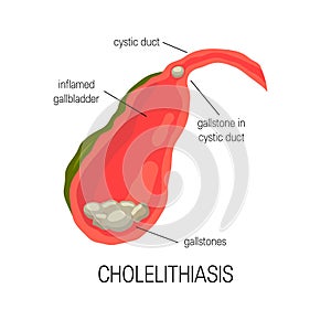 Inflamed gallbladder, cholelithiasis concept photo