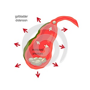 Inflamed gallbladder, cholelithiasis concept photo