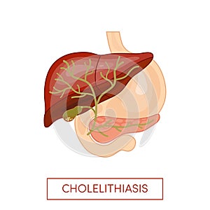 Cholelithiasis - gallstone disease photo
