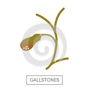 Cholelithiasis - gallstone disease photo