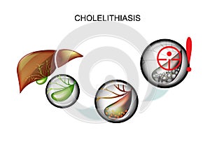 Cholelithiasis. hepatic colic