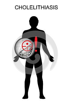 Cholelithiasis. hepatic colic