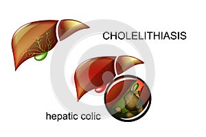 Cholelithiasis. Stones in the gallbladder.