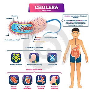 Cholera vector illustration. Labeled infection structure and symptom scheme