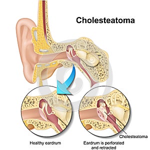 Cholesteatoma human ear anatomy  illustraton on white background photo