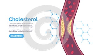 Cholesterol artery thrombosis micro vascular desease. Arteriosclerosis blood vector atherosclerosis risk