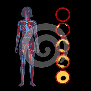 Cholesterol and atherosclerosis