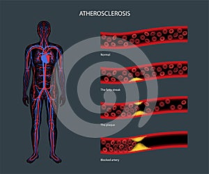 Cholesterol and atherosclerosis